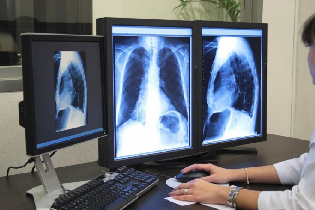 легкие рак рентген флюорография