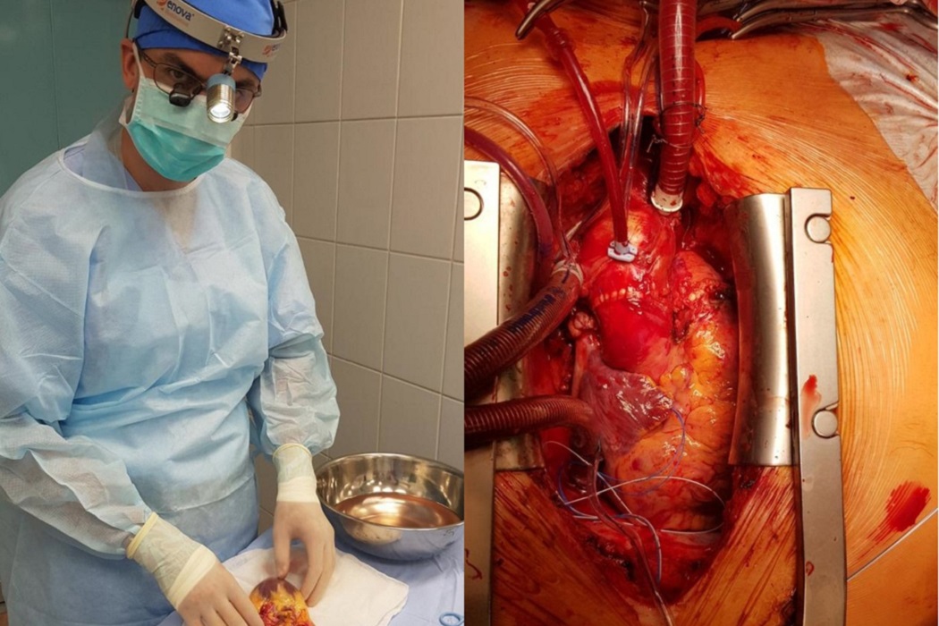 В ОКБ Ханты-Мансийска впервые выполнили трансплантацию сердца