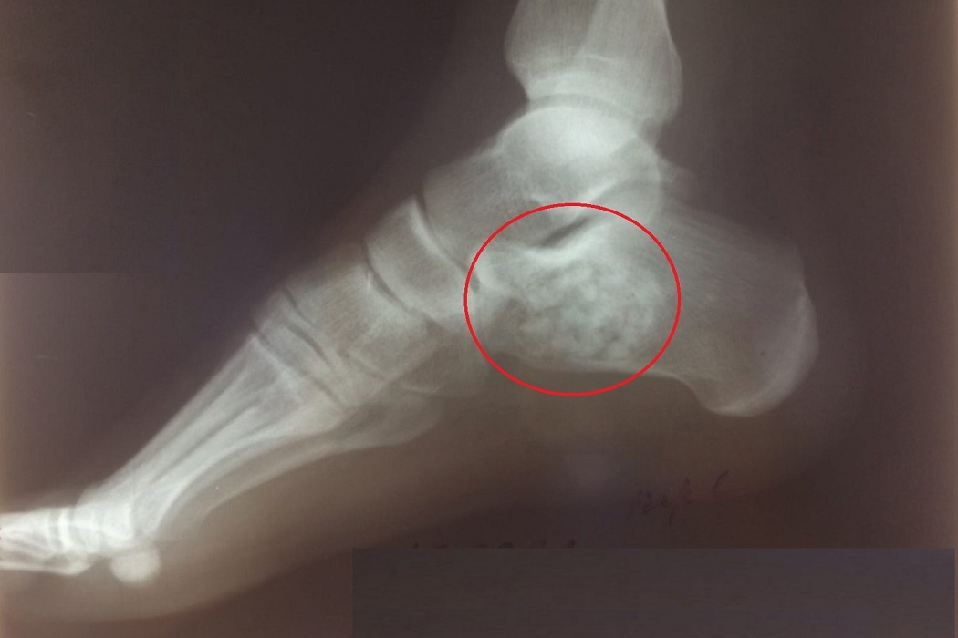 В Тюмени двум спортсменам с кистами в пятке установили искусственную кость