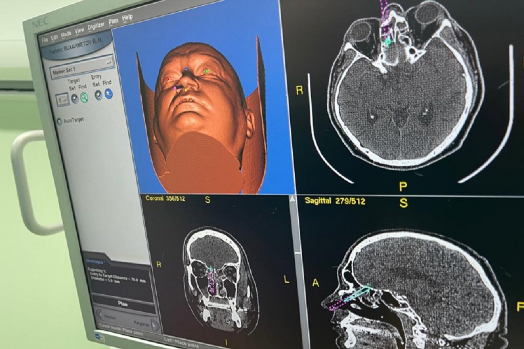 Врачи Сургута прооперировали пациента с абцессом в головном мозге